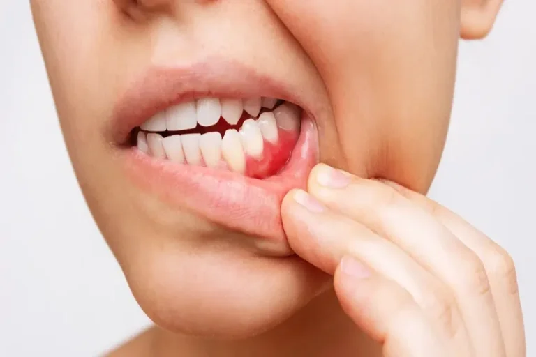 Gum Disease Prevention Tips for Healthy Gums Daily Gum Disease Prevention Tips for Healthy Gums Daily
